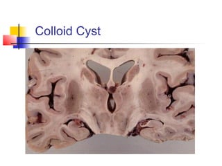 Colloid Cyst
 