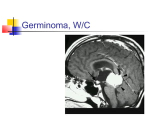 Germinoma, W/C
 