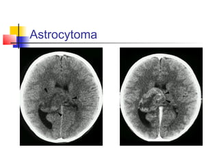 Astrocytoma
 
