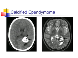 Calcified Ependymoma
 