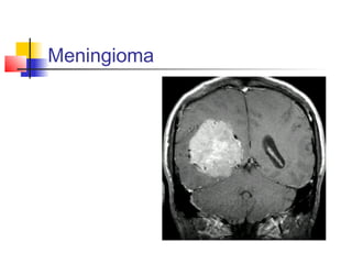 Meningioma
 