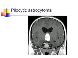 Pilocytic astrocytoma
 
