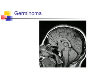 Germinoma
 