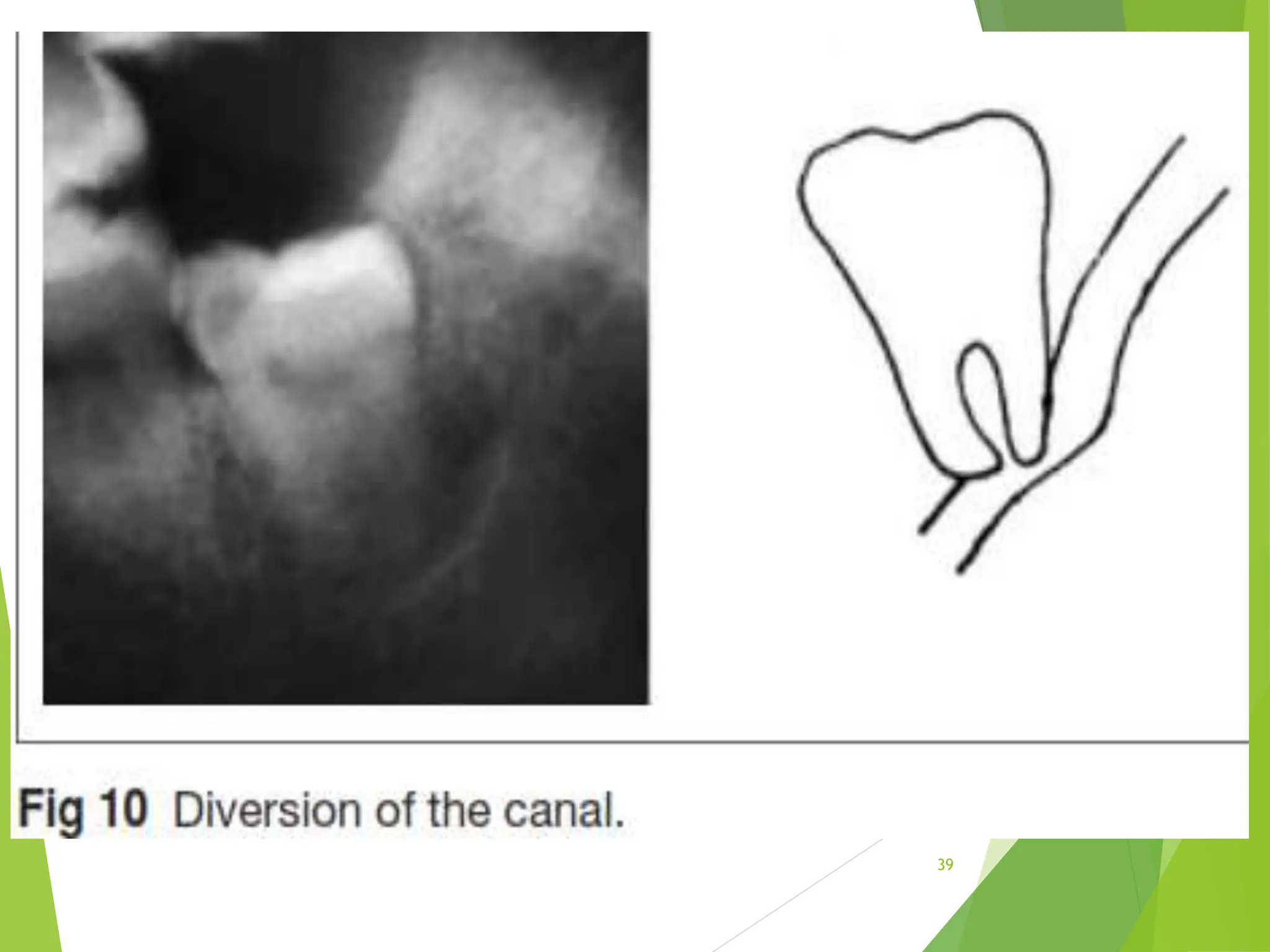 THIRD MOLAR IMPACTed tooth , development & Surgical complications.pptx