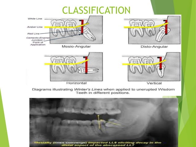 THIRD MOLAR IMPACTed tooth , development & Surgical complications.pptx