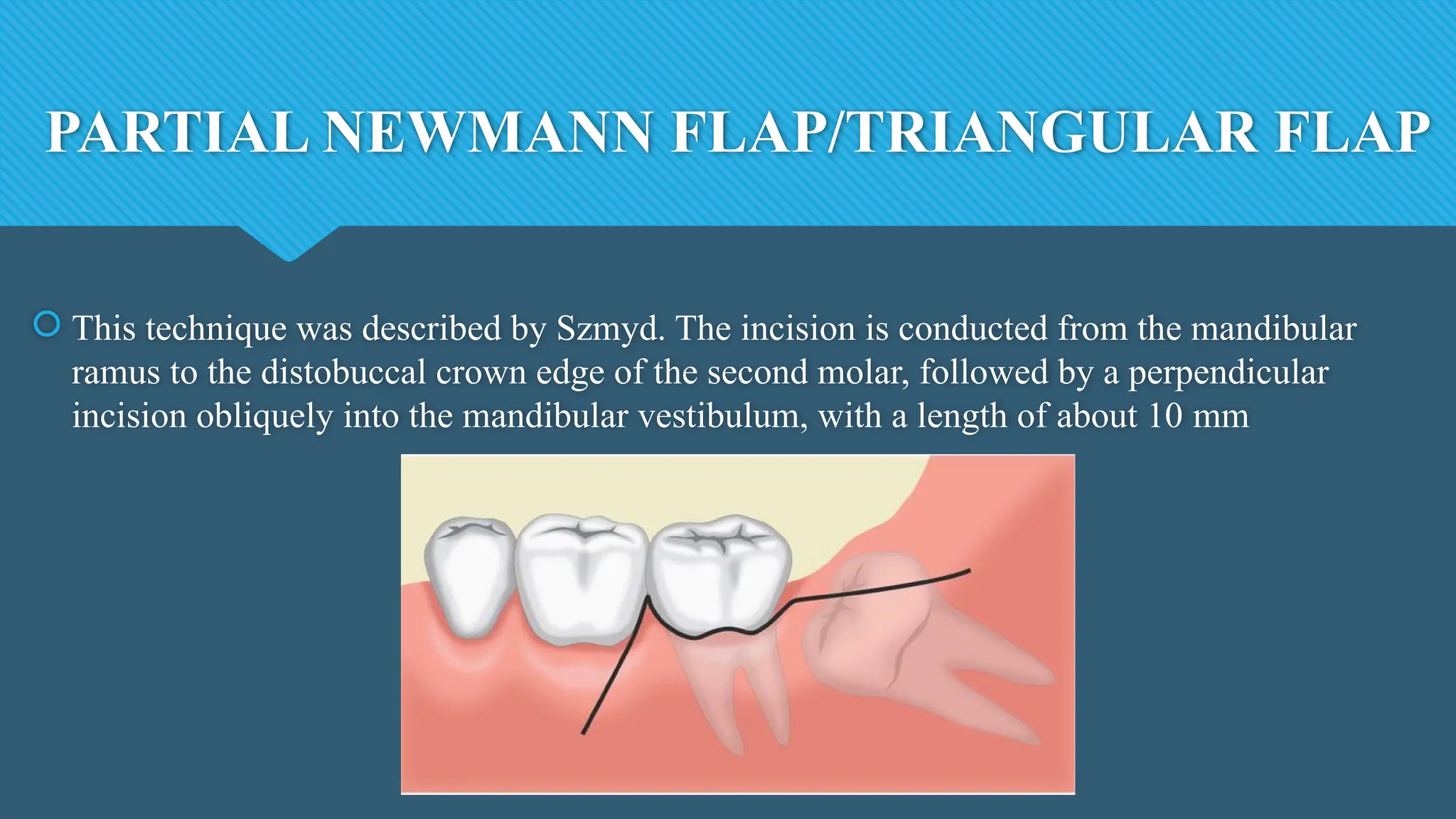 PARTIAL NEWMANN FLAP/TRIANGULAR FLAP
 This technique was described by Szmyd. The incision is conducted from the mandibular
ramus to the distobuccal crown edge of the second molar, followed by a perpendicular
incision obliquely into the mandibular vestibulum, with a length of about 10 mm
 