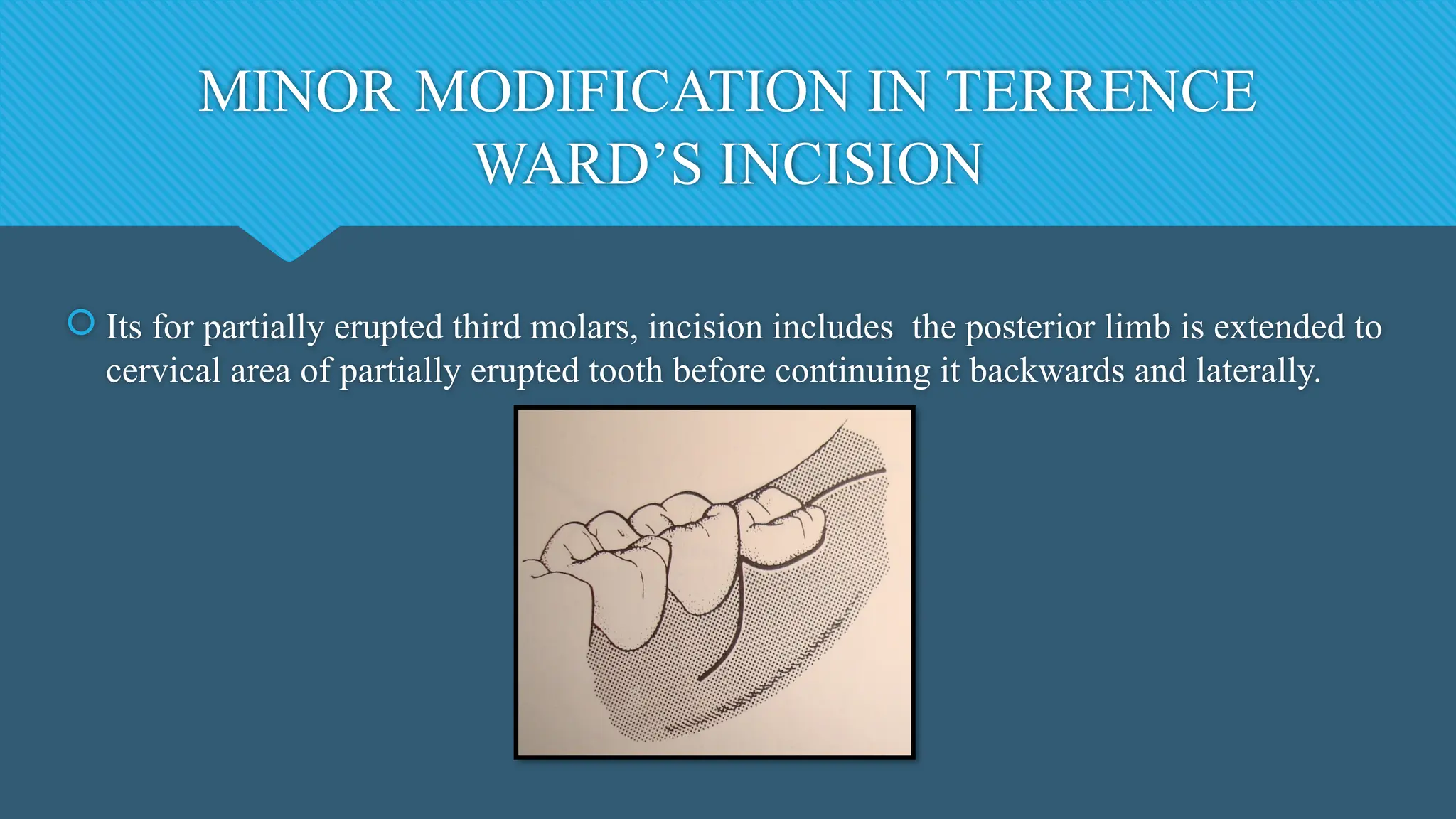 MINOR MODIFICATION IN TERRENCE
WARD’S INCISION
 Its for partially erupted third molars, incision includes the posterior limb is extended to
cervical area of partially erupted tooth before continuing it backwards and laterally.
 