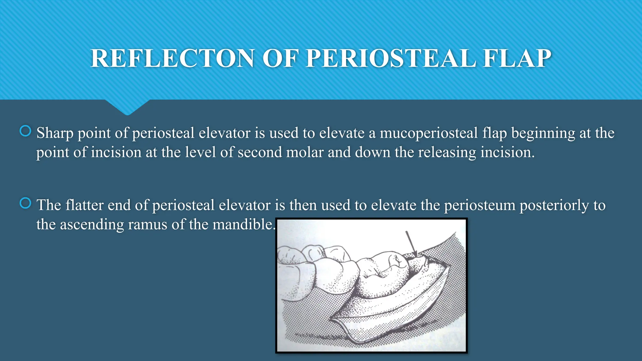 REFLECTON OF PERIOSTEAL FLAP
 Sharp point of periosteal elevator is used to elevate a mucoperiosteal flap beginning at the
point of incision at the level of second molar and down the releasing incision.
 The flatter end of periosteal elevator is then used to elevate the periosteum posteriorly to
the ascending ramus of the mandible.
 