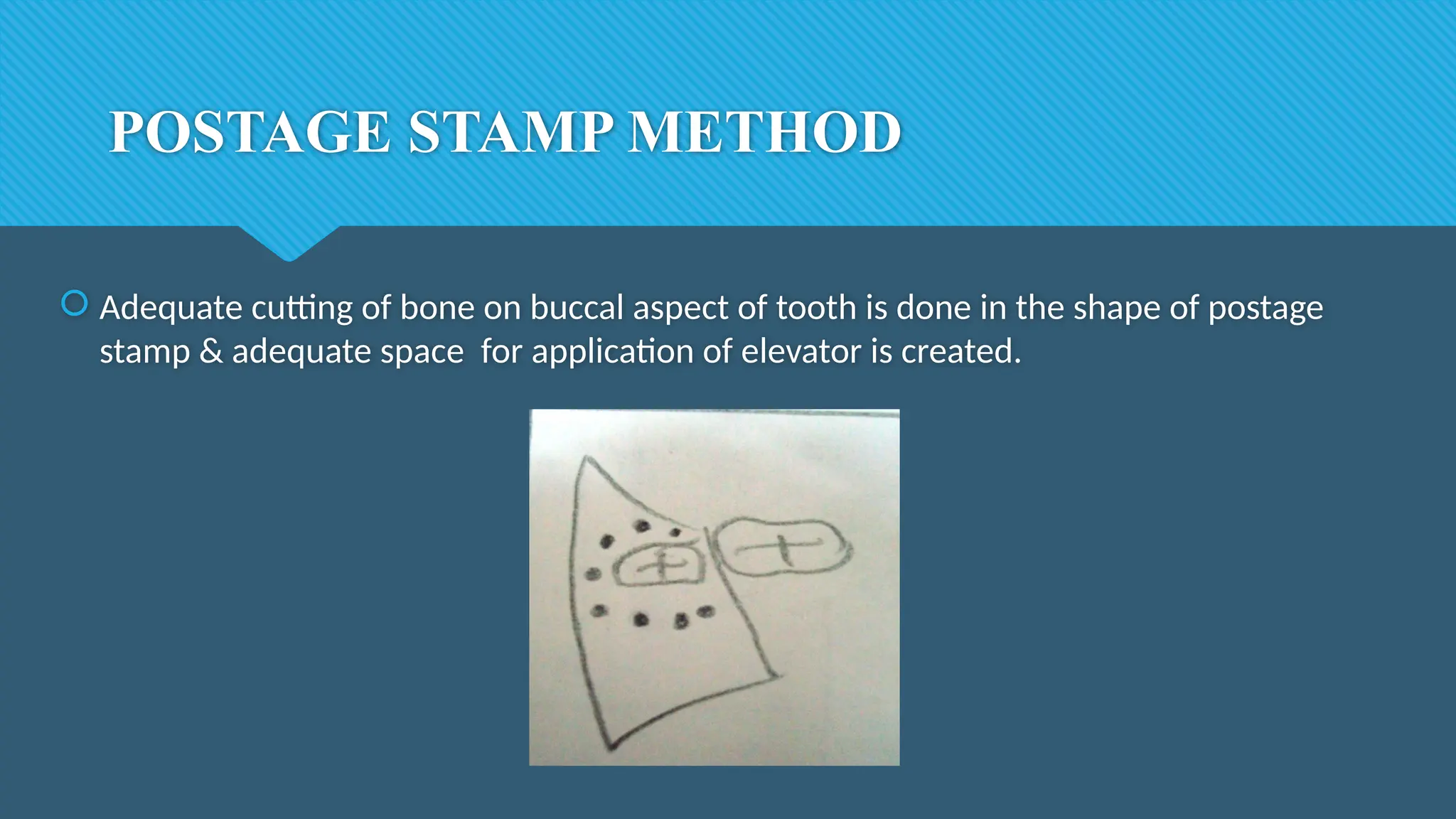 POSTAGE STAMP METHOD
 Adequate cutting of bone on buccal aspect of tooth is done in the shape of postage
stamp & adequate space for application of elevator is created.
 