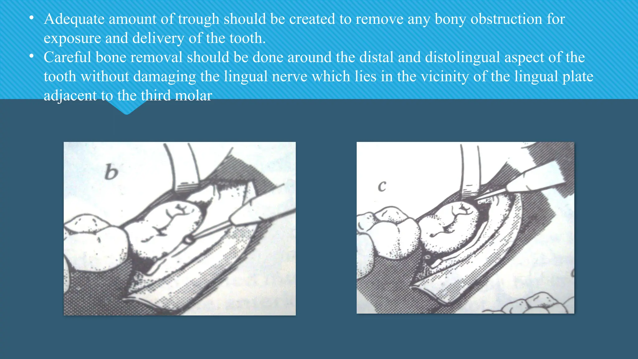 • Adequate amount of trough should be created to remove any bony obstruction for
exposure and delivery of the tooth.
• Careful bone removal should be done around the distal and distolingual aspect of the
tooth without damaging the lingual nerve which lies in the vicinity of the lingual plate
adjacent to the third molar
 