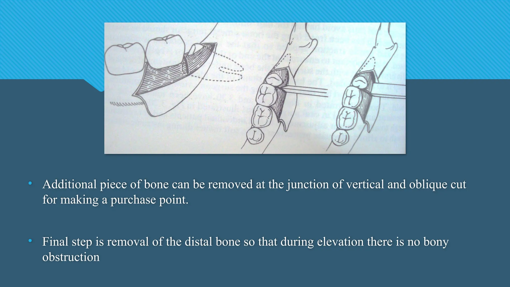• Additional piece of bone can be removed at the junction of vertical and oblique cut
for making a purchase point.
• Final step is removal of the distal bone so that during elevation there is no bony
obstruction
 