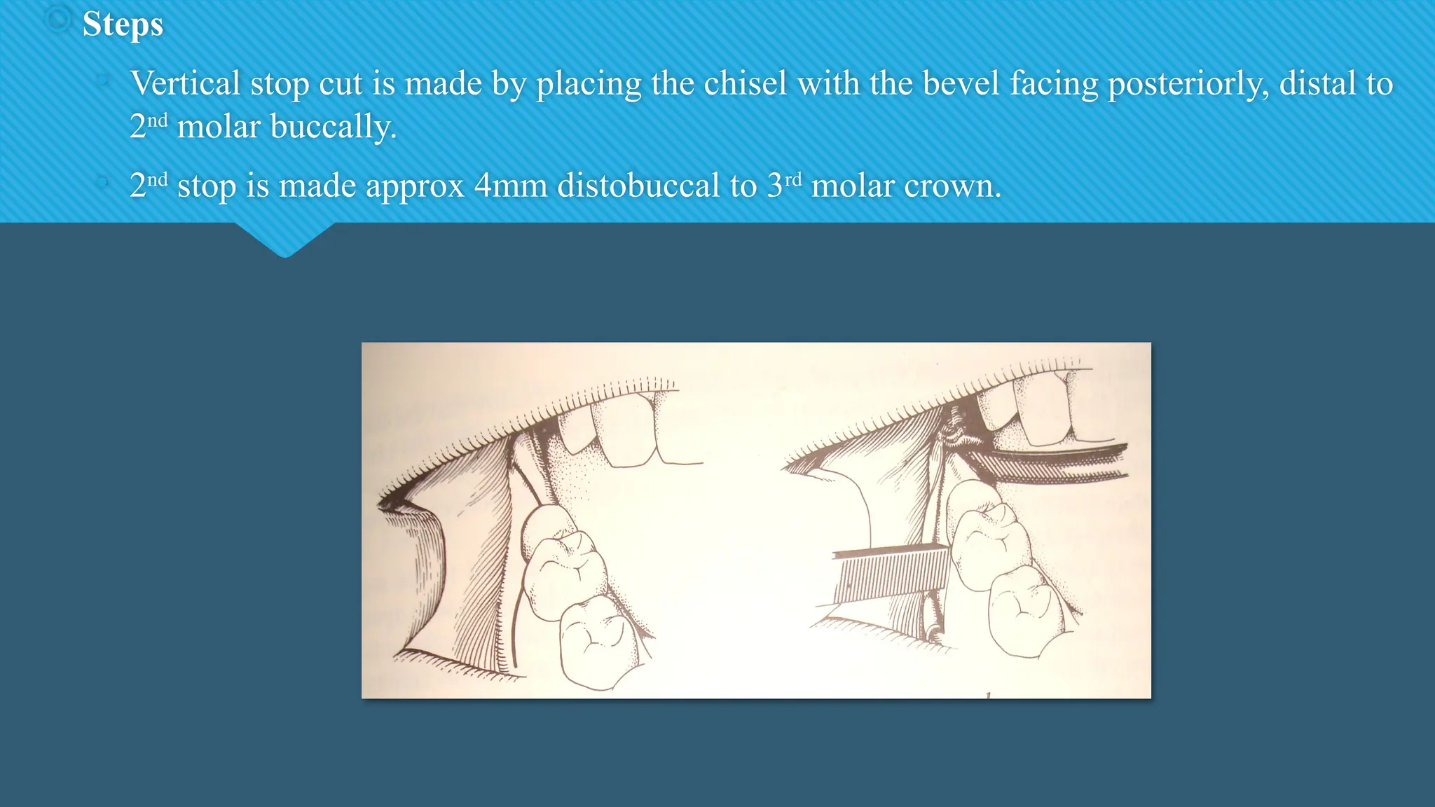  Steps
• Vertical stop cut is made by placing the chisel with the bevel facing posteriorly, distal to
2nd
molar buccally.
• 2nd
stop is made approx 4mm distobuccal to 3rd
molar crown.
 