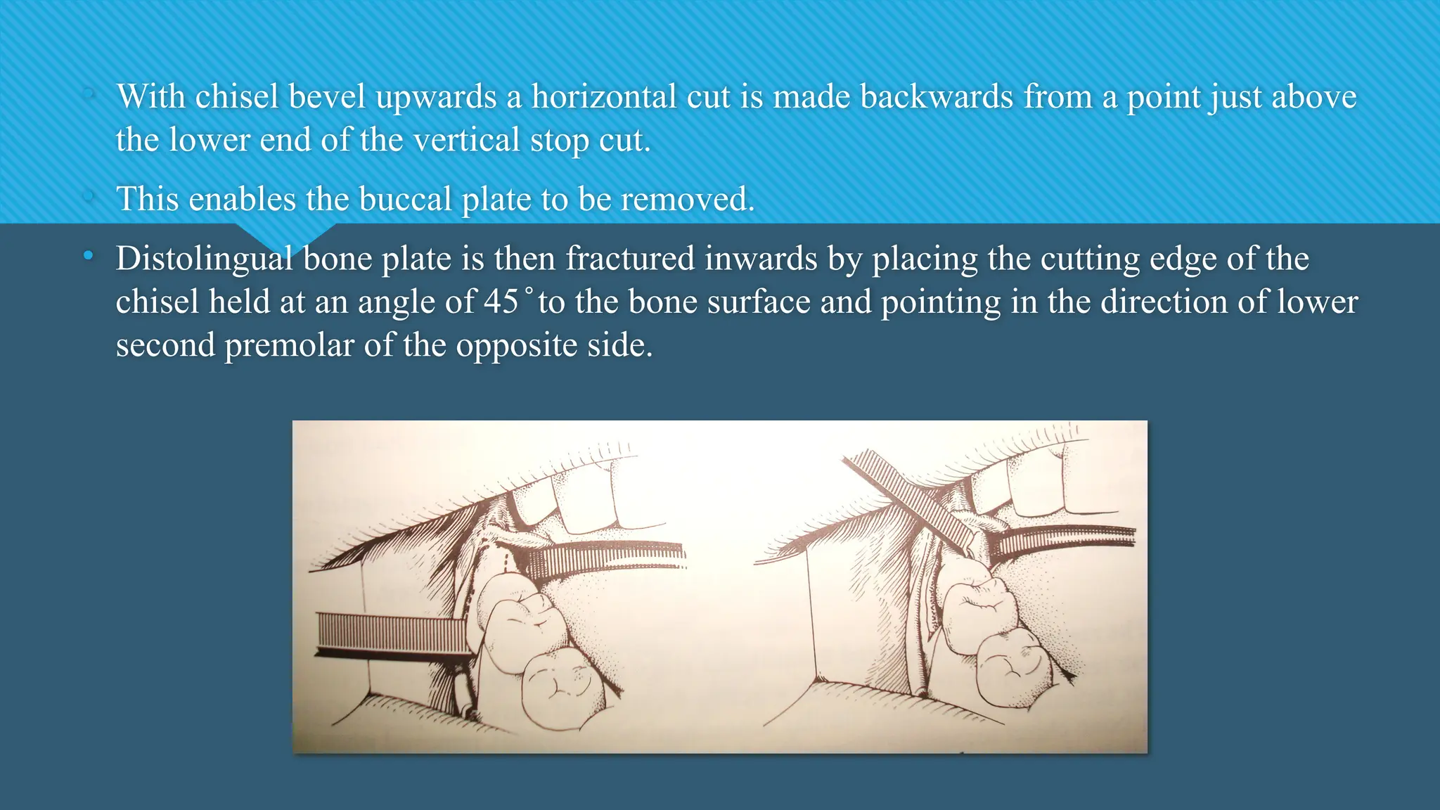 • With chisel bevel upwards a horizontal cut is made backwards from a point just above
the lower end of the vertical stop cut.
• This enables the buccal plate to be removed.
• Distolingual bone plate is then fractured inwards by placing the cutting edge of the
chisel held at an angle of 45 to the bone surface and pointing in the direction of lower
̊
second premolar of the opposite side.
 