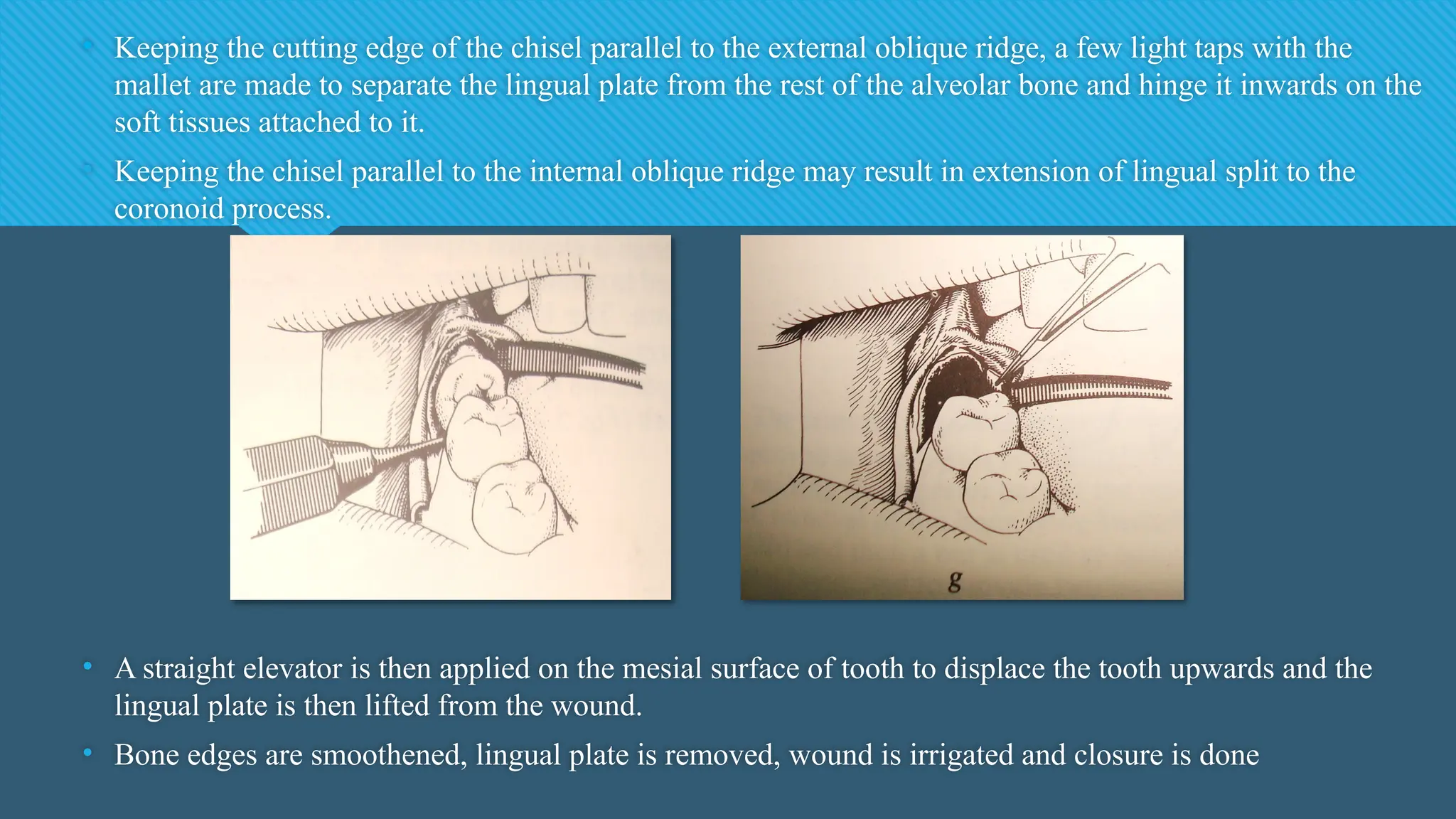 • Keeping the cutting edge of the chisel parallel to the external oblique ridge, a few light taps with the
mallet are made to separate the lingual plate from the rest of the alveolar bone and hinge it inwards on the
soft tissues attached to it.
• Keeping the chisel parallel to the internal oblique ridge may result in extension of lingual split to the
coronoid process.
• A straight elevator is then applied on the mesial surface of tooth to displace the tooth upwards and the
lingual plate is then lifted from the wound.
• Bone edges are smoothened, lingual plate is removed, wound is irrigated and closure is done
 