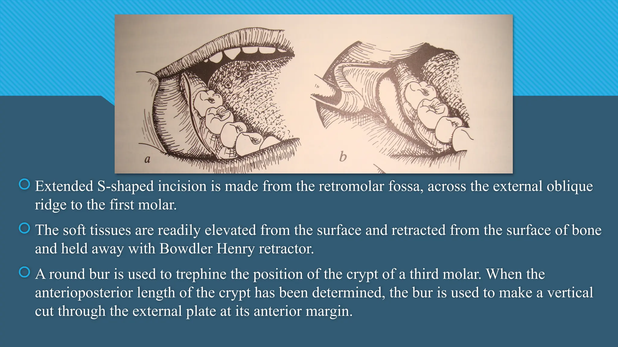  Extended S-shaped incision is made from the retromolar fossa, across the external oblique
ridge to the first molar.
 The soft tissues are readily elevated from the surface and retracted from the surface of bone
and held away with Bowdler Henry retractor.
 A round bur is used to trephine the position of the crypt of a third molar. When the
anterioposterior length of the crypt has been determined, the bur is used to make a vertical
cut through the external plate at its anterior margin.
 