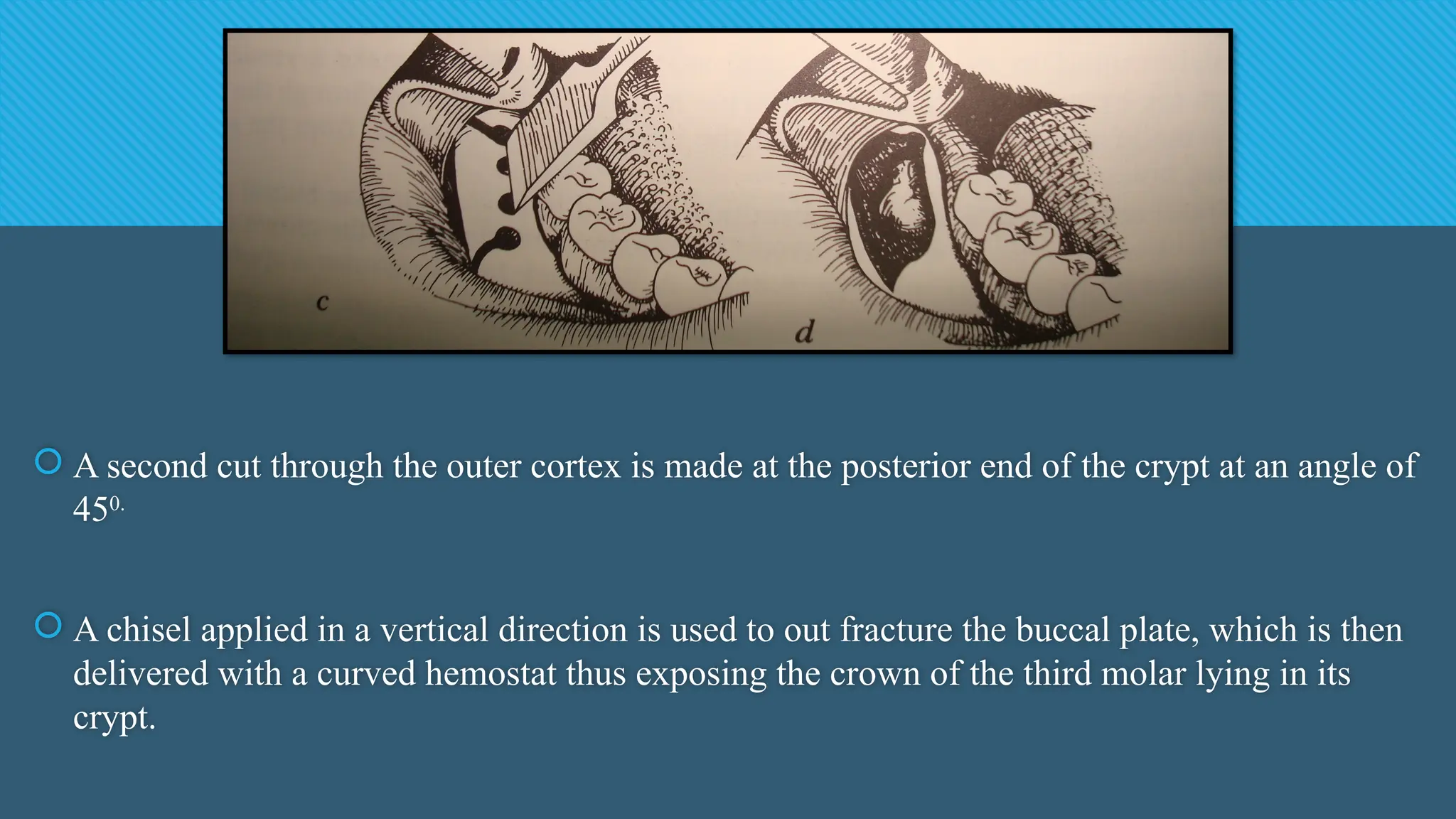  A second cut through the outer cortex is made at the posterior end of the crypt at an angle of
450.
 A chisel applied in a vertical direction is used to out fracture the buccal plate, which is then
delivered with a curved hemostat thus exposing the crown of the third molar lying in its
crypt.
 
