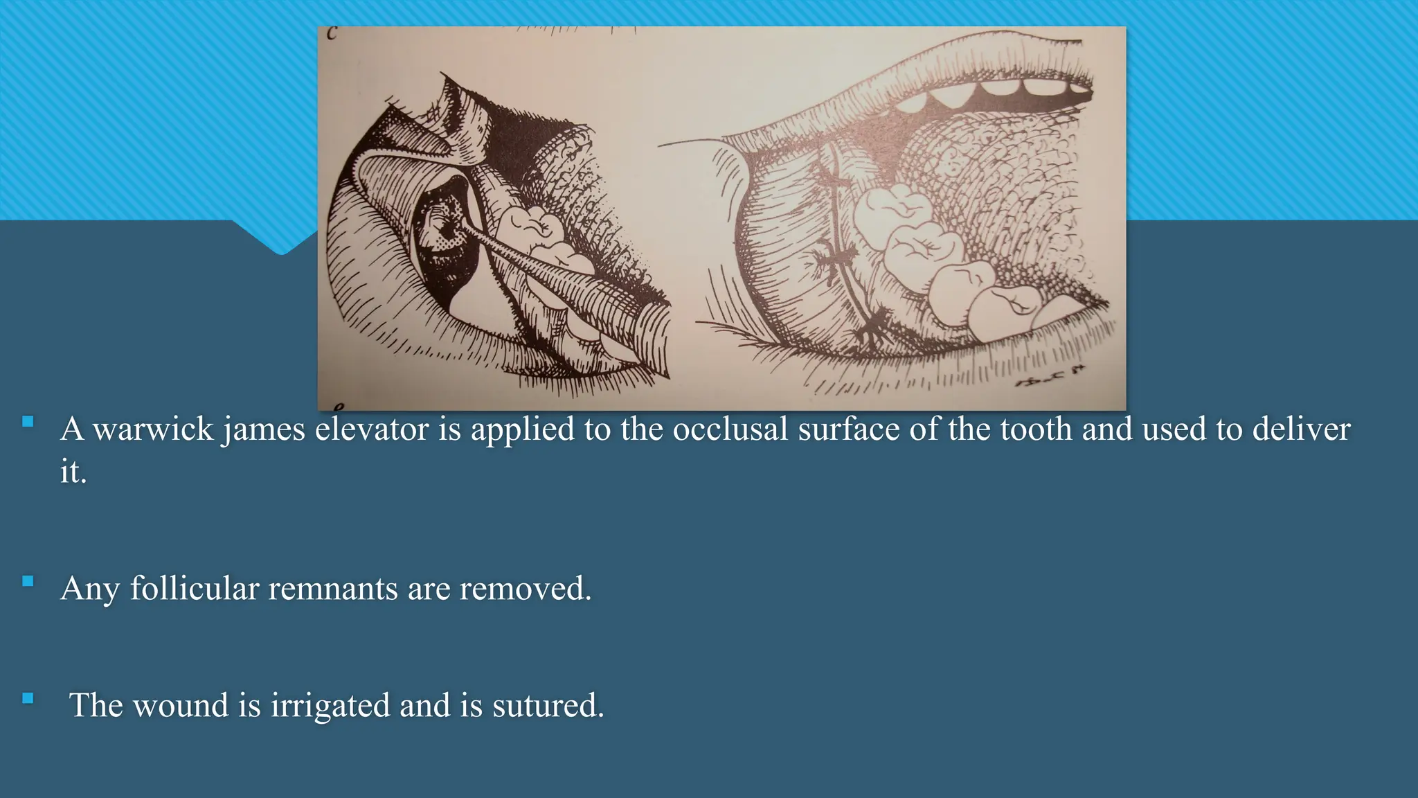  A warwick james elevator is applied to the occlusal surface of the tooth and used to deliver
it.
 Any follicular remnants are removed.
 The wound is irrigated and is sutured.
 
