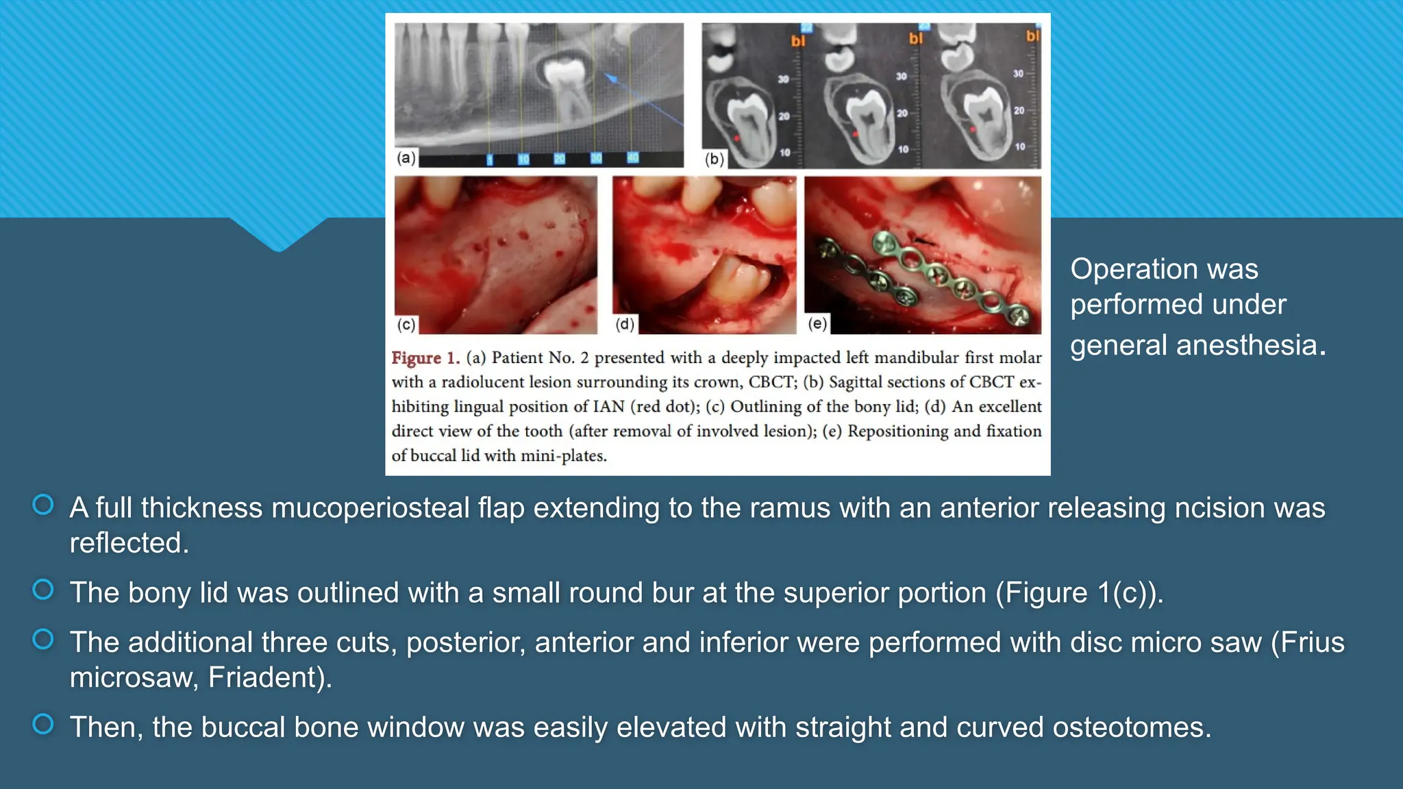  A full thickness mucoperiosteal flap extending to the ramus with an anterior releasing ncision was
reflected.
 The bony lid was outlined with a small round bur at the superior portion (Figure 1(c)).
 The additional three cuts, posterior, anterior and inferior were performed with disc micro saw (Frius
microsaw, Friadent).
 Then, the buccal bone window was easily elevated with straight and curved osteotomes.
Operation was
performed under
general anesthesia.
 