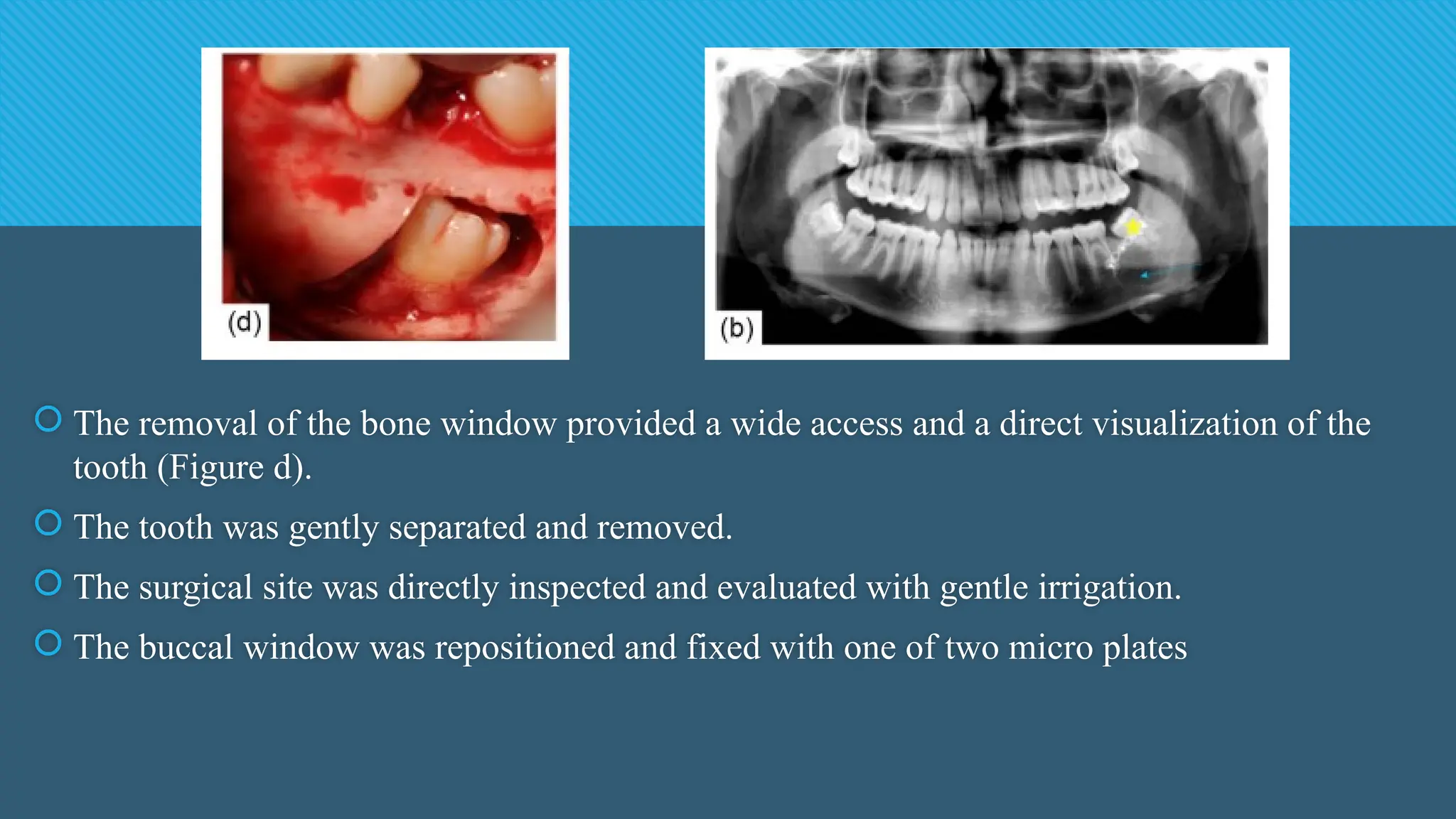  The removal of the bone window provided a wide access and a direct visualization of the
tooth (Figure d).
 The tooth was gently separated and removed.
 The surgical site was directly inspected and evaluated with gentle irrigation.
 The buccal window was repositioned and fixed with one of two micro plates
 