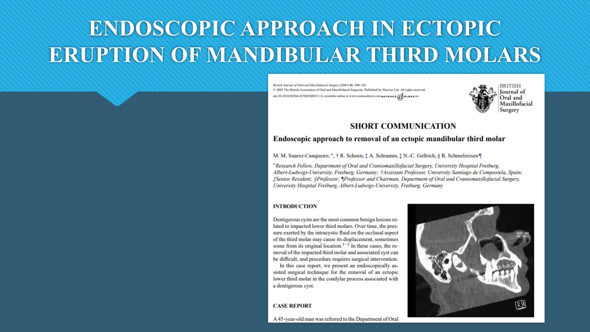 ENDOSCOPIC APPROACH IN ECTOPIC
ERUPTION OF MANDIBULAR THIRD MOLARS
 