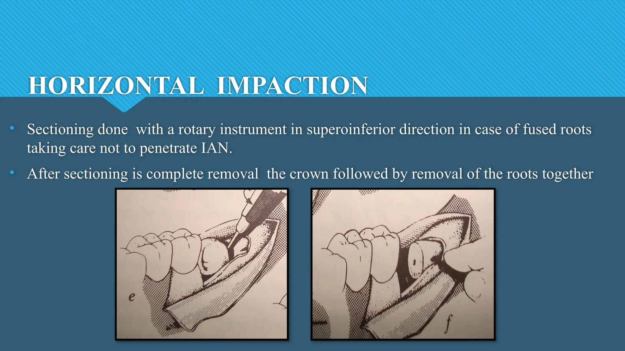 HORIZONTAL IMPACTION
• Sectioning done with a rotary instrument in superoinferior direction in case of fused roots
taking care not to penetrate IAN.
• After sectioning is complete removal the crown followed by removal of the roots together
 