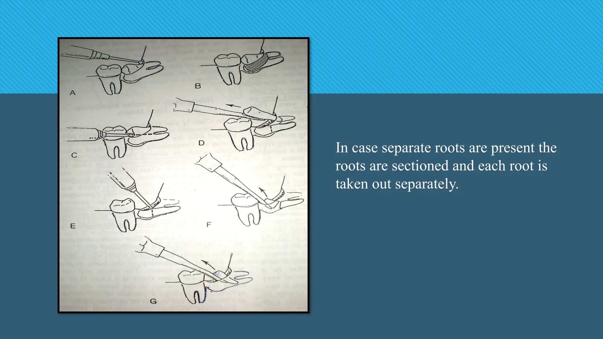 In case separate roots are present the
roots are sectioned and each root is
taken out separately.
 
