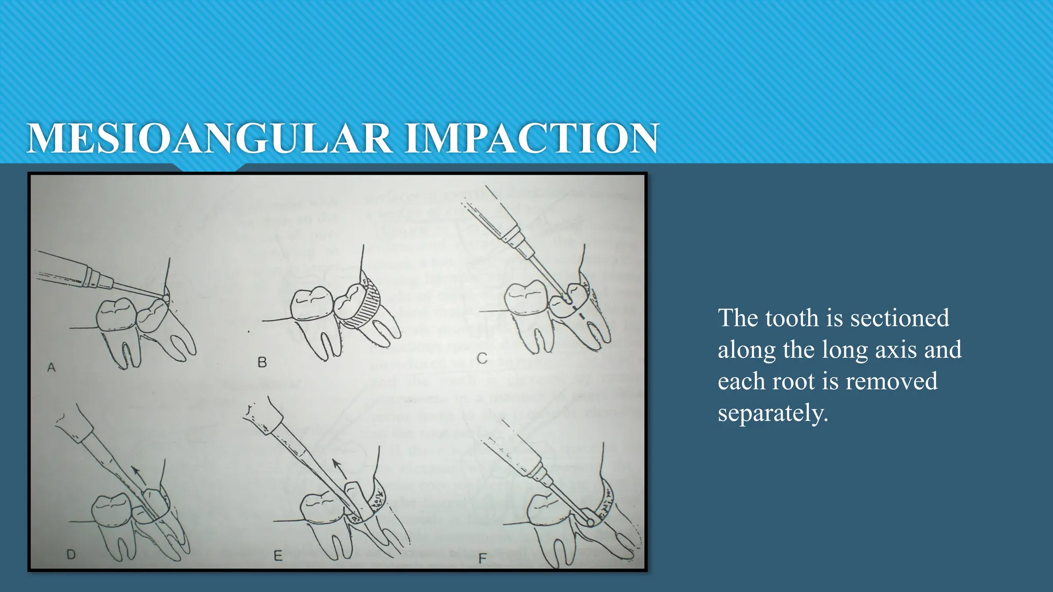 MESIOANGULAR IMPACTION
The tooth is sectioned
along the long axis and
each root is removed
separately.
 