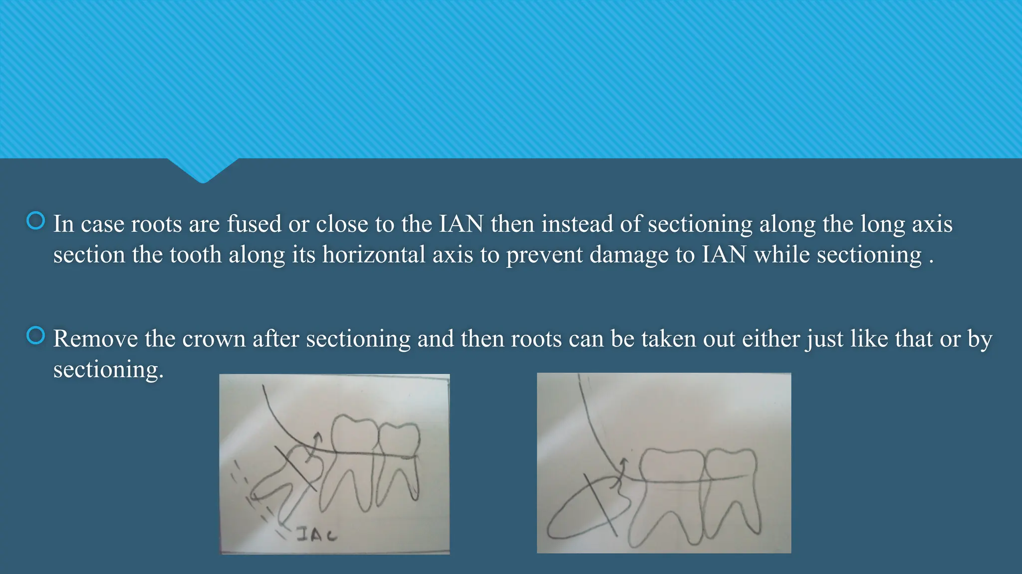 In case roots are fused or close to the IAN then instead of sectioning along the long axis
section the tooth along its horizontal axis to prevent damage to IAN while sectioning .
 Remove the crown after sectioning and then roots can be taken out either just like that or by
sectioning.
 