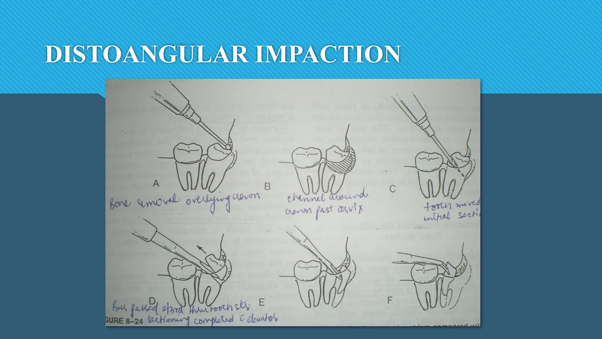 DISTOANGULAR IMPACTION
 