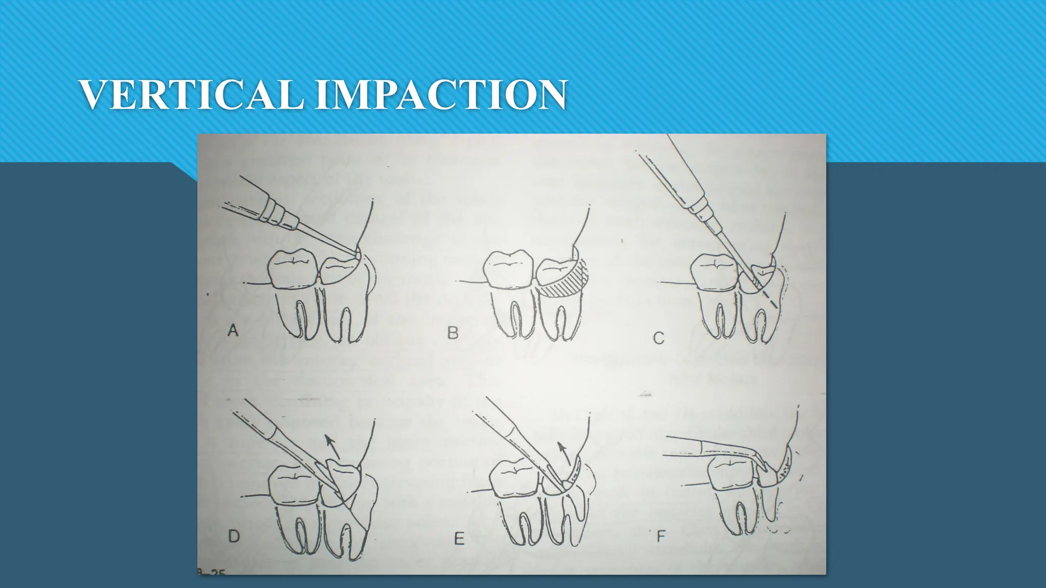 VERTICAL IMPACTION
 
