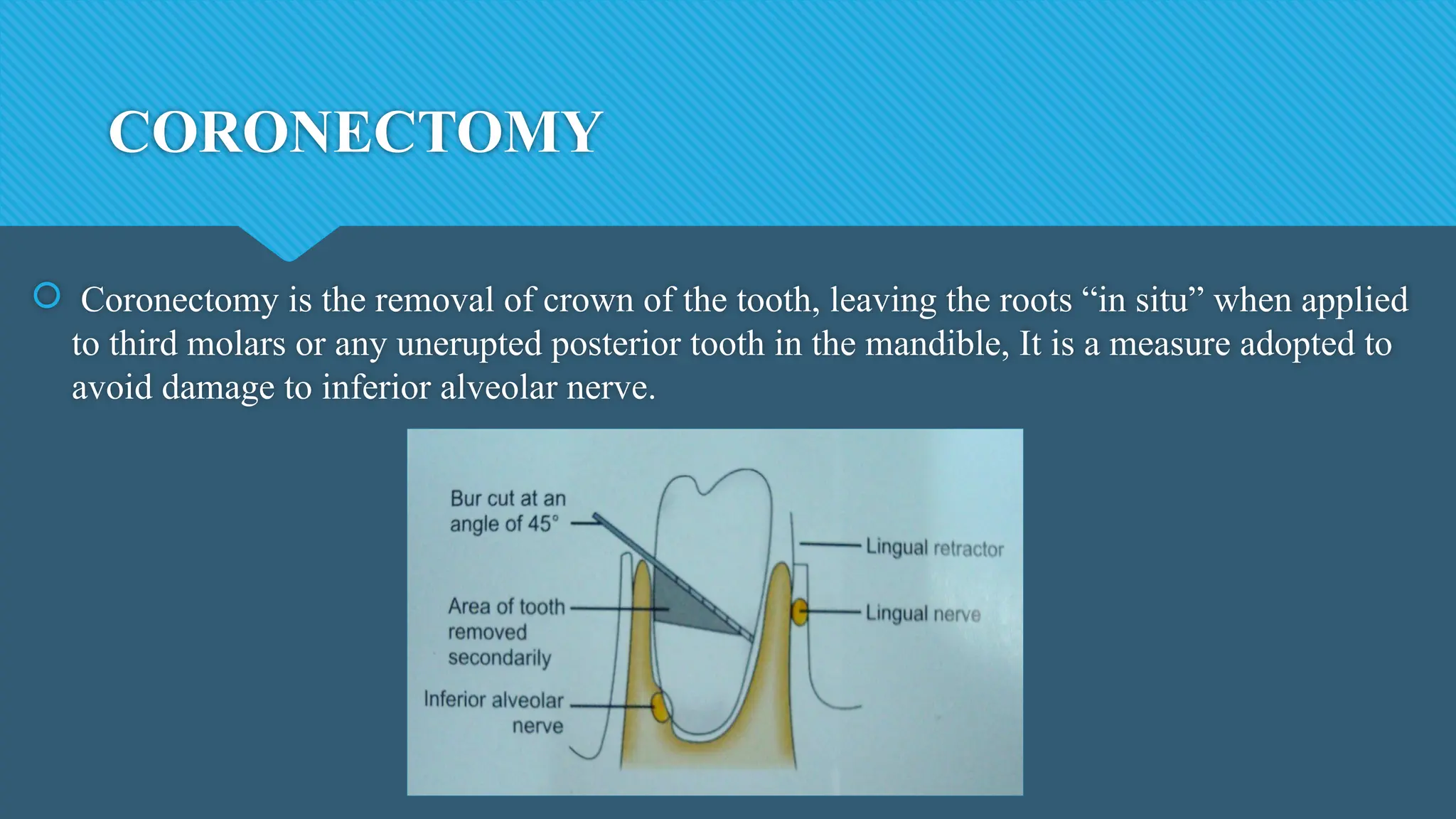 CORONECTOMY
 Coronectomy is the removal of crown of the tooth, leaving the roots “in situ” when applied
to third molars or any unerupted posterior tooth in the mandible, It is a measure adopted to
avoid damage to inferior alveolar nerve.
 