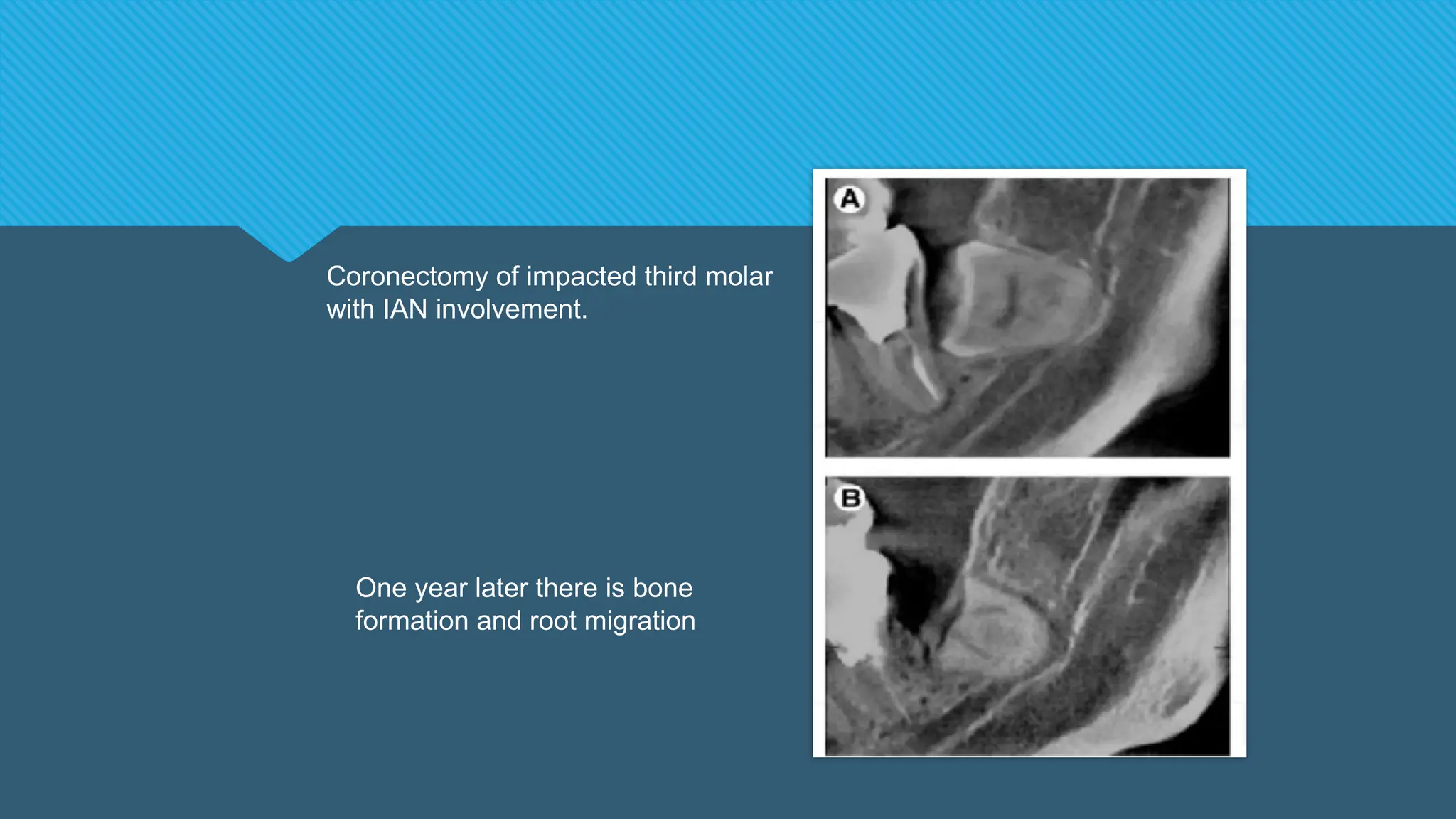 Coronectomy of impacted third molar
with IAN involvement.
One year later there is bone
formation and root migration
 