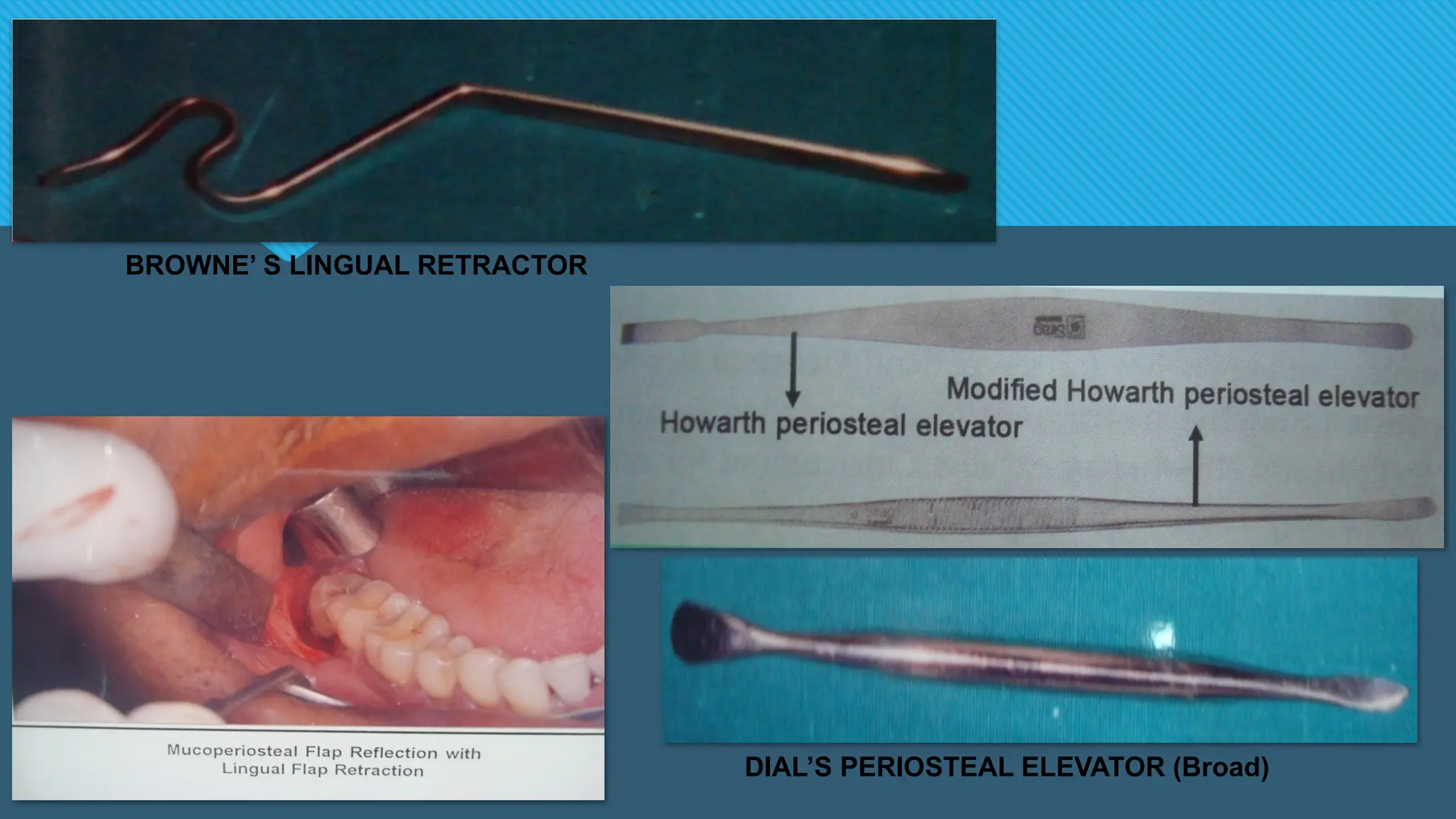 BROWNE’ S LINGUAL RETRACTOR
DIAL’S PERIOSTEAL ELEVATOR (Broad)
 