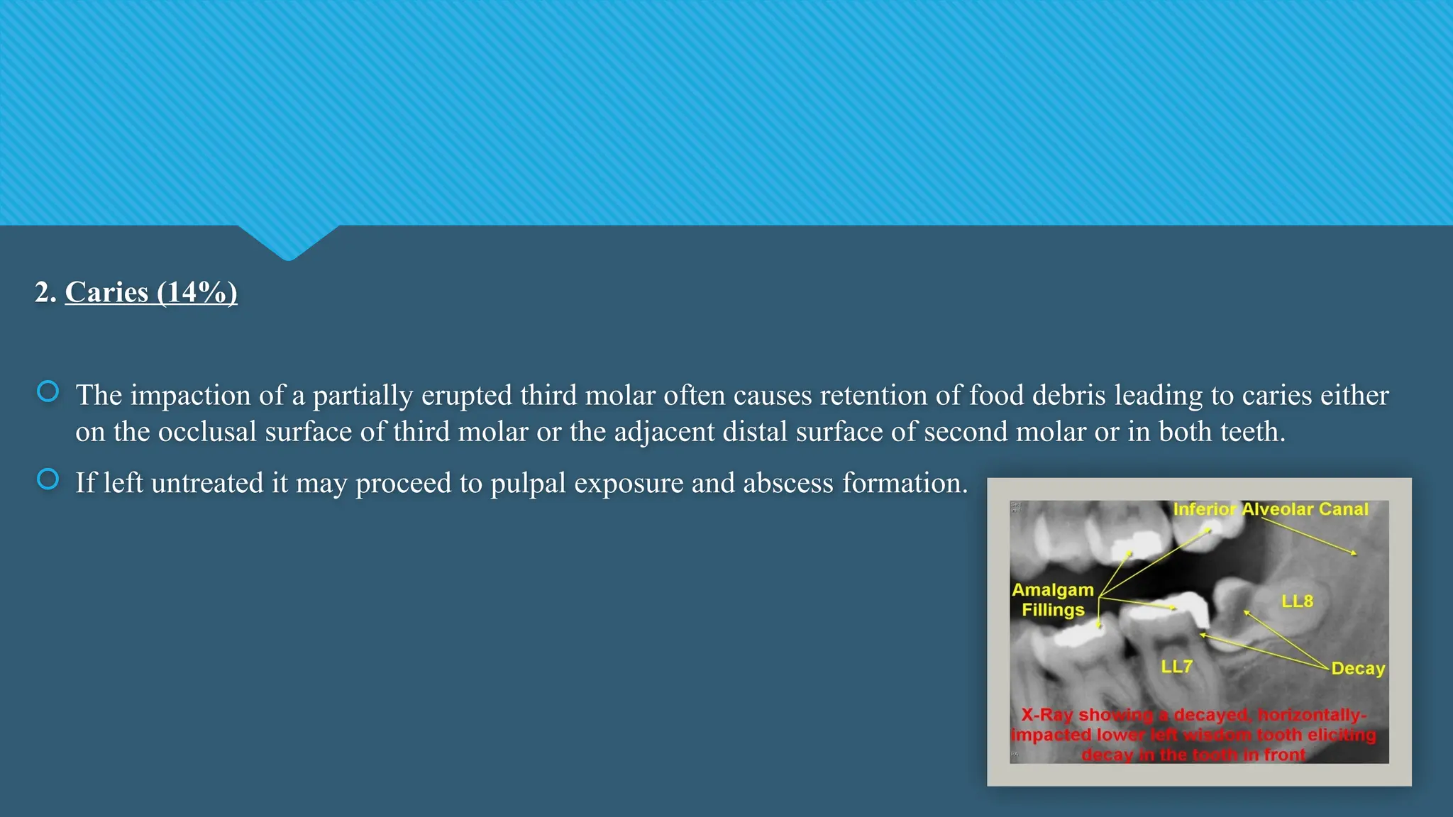2. Caries (14%)
 The impaction of a partially erupted third molar often causes retention of food debris leading to caries either
on the occlusal surface of third molar or the adjacent distal surface of second molar or in both teeth.
 If left untreated it may proceed to pulpal exposure and abscess formation.
 