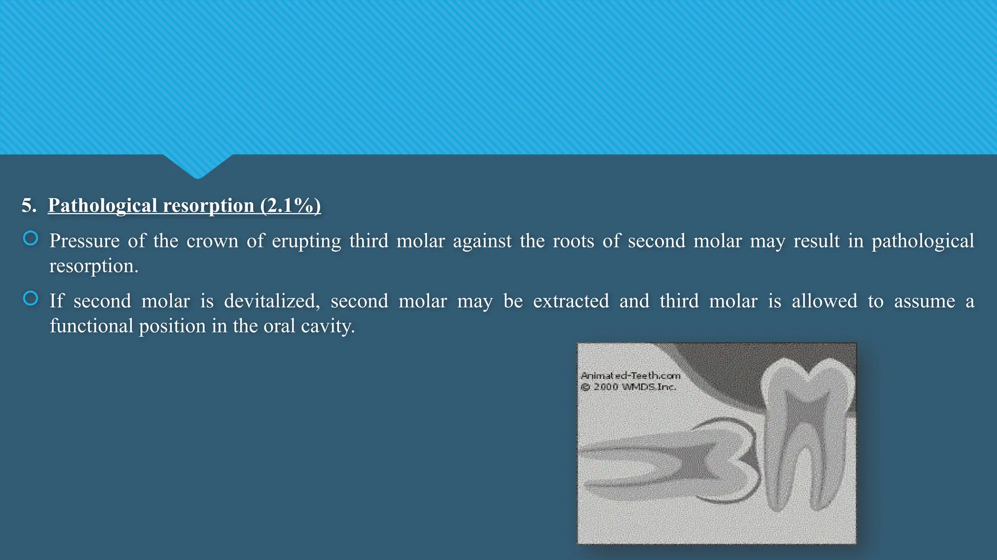 5. Pathological resorption (2.1%)
 Pressure of the crown of erupting third molar against the roots of second molar may result in pathological
resorption.
 If second molar is devitalized, second molar may be extracted and third molar is allowed to assume a
functional position in the oral cavity.
 