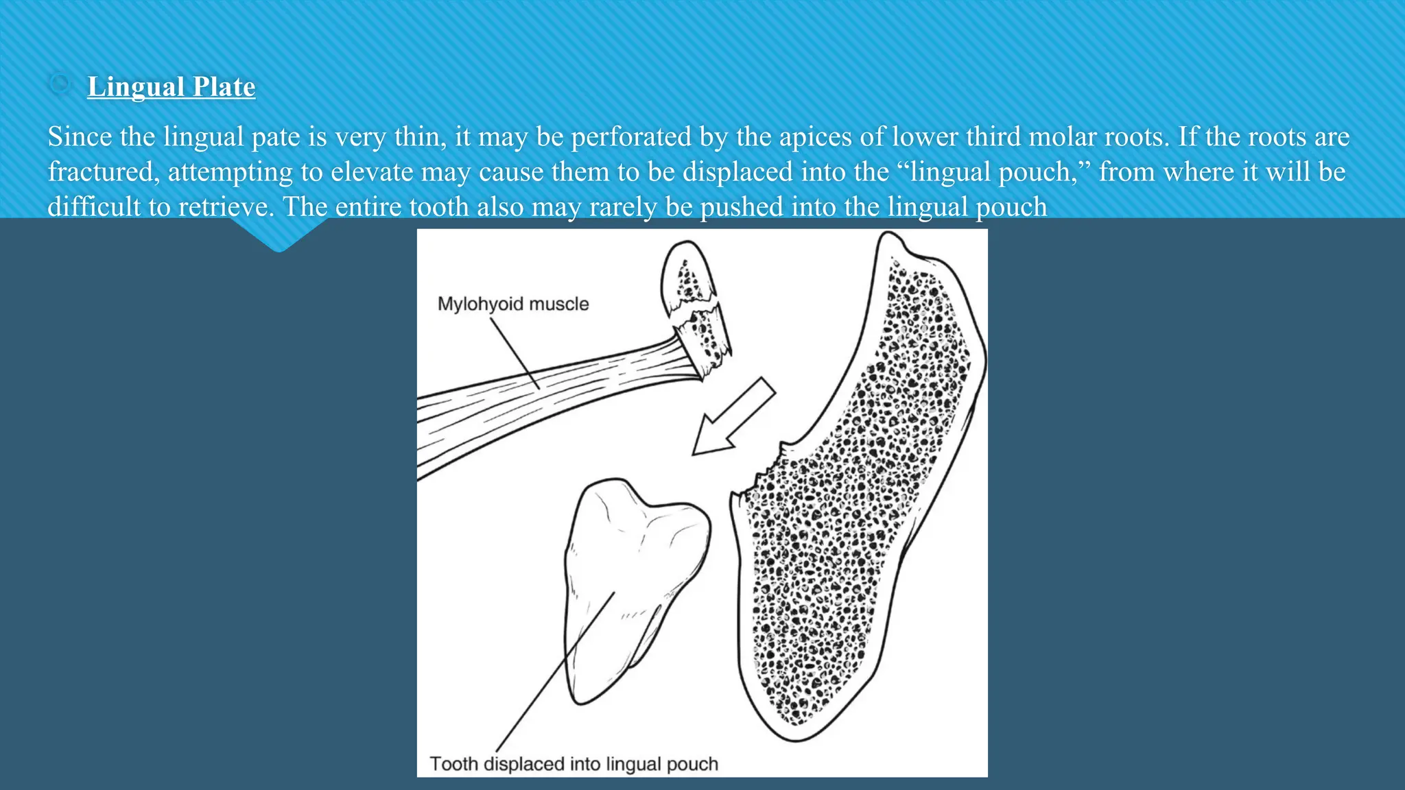  Lingual Plate
Since the lingual pate is very thin, it may be perforated by the apices of lower third molar roots. If the roots are
fractured, attempting to elevate may cause them to be displaced into the “lingual pouch,” from where it will be
difficult to retrieve. The entire tooth also may rarely be pushed into the lingual pouch
 