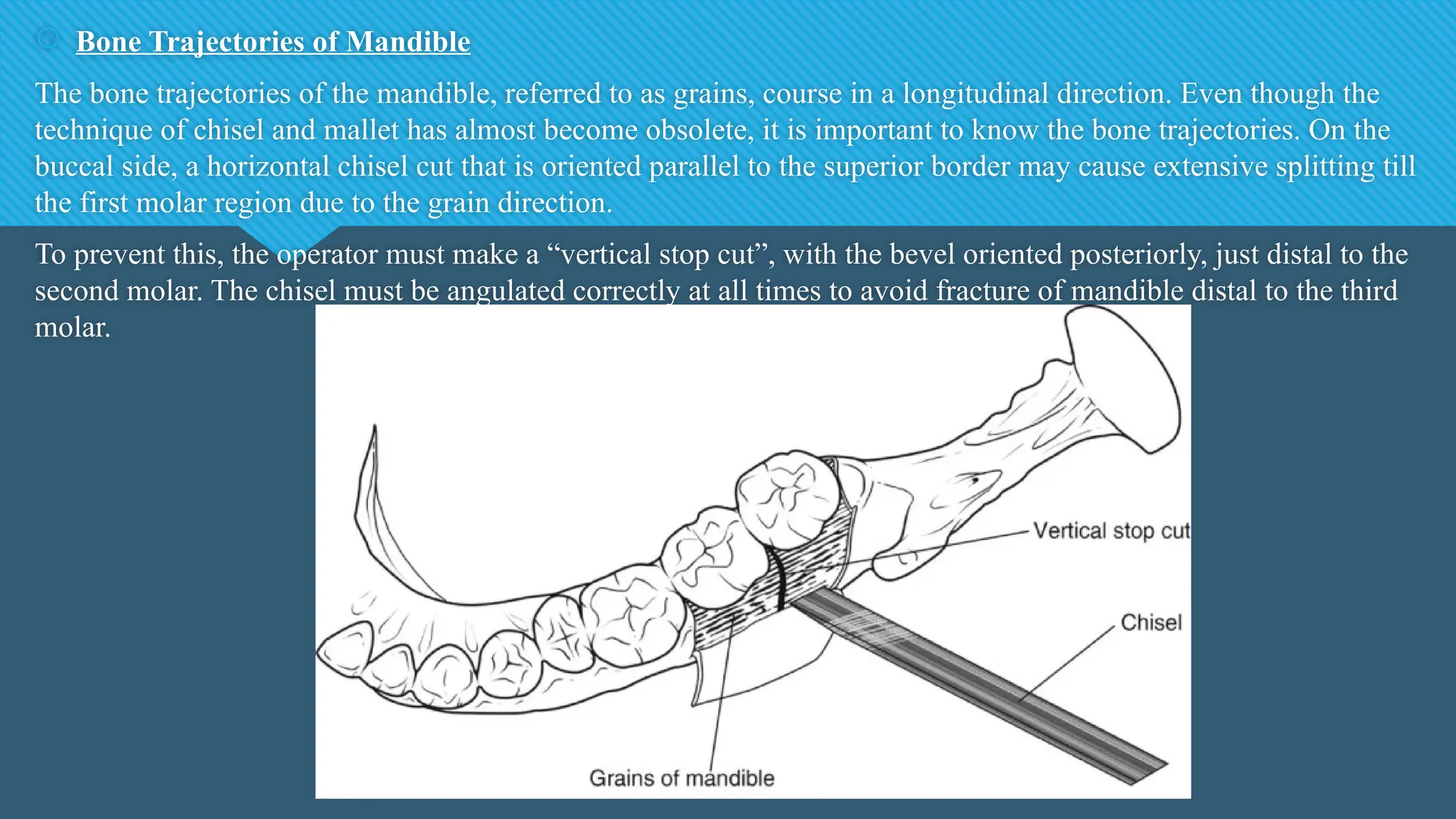  Bone Trajectories of Mandible
The bone trajectories of the mandible, referred to as grains, course in a longitudinal direction. Even though the
technique of chisel and mallet has almost become obsolete, it is important to know the bone trajectories. On the
buccal side, a horizontal chisel cut that is oriented parallel to the superior border may cause extensive splitting till
the first molar region due to the grain direction.
To prevent this, the operator must make a “vertical stop cut”, with the bevel oriented posteriorly, just distal to the
second molar. The chisel must be angulated correctly at all times to avoid fracture of mandible distal to the third
molar.
 
