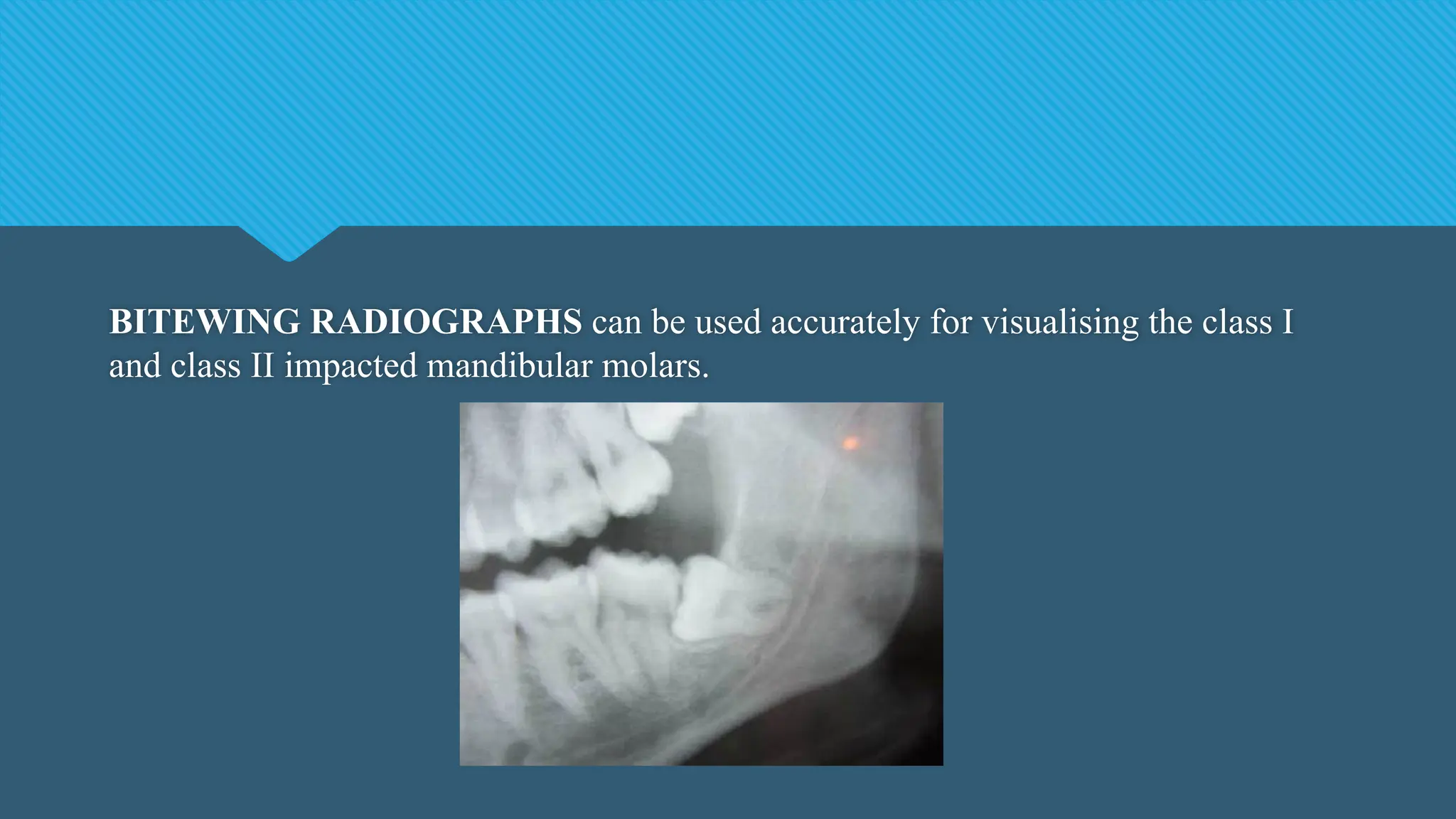 BITEWING RADIOGRAPHS can be used accurately for visualising the class I
and class II impacted mandibular molars.
 