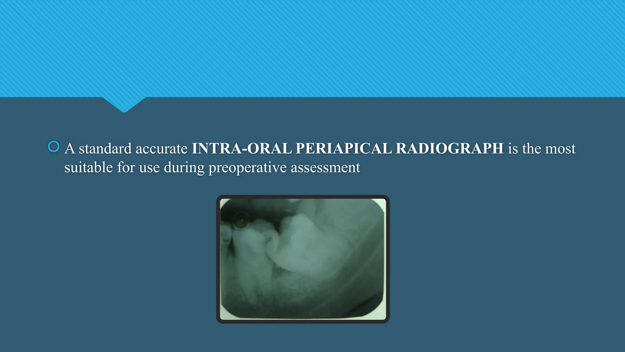  A standard accurate INTRA-ORAL PERIAPICAL RADIOGRAPH is the most
suitable for use during preoperative assessment
 