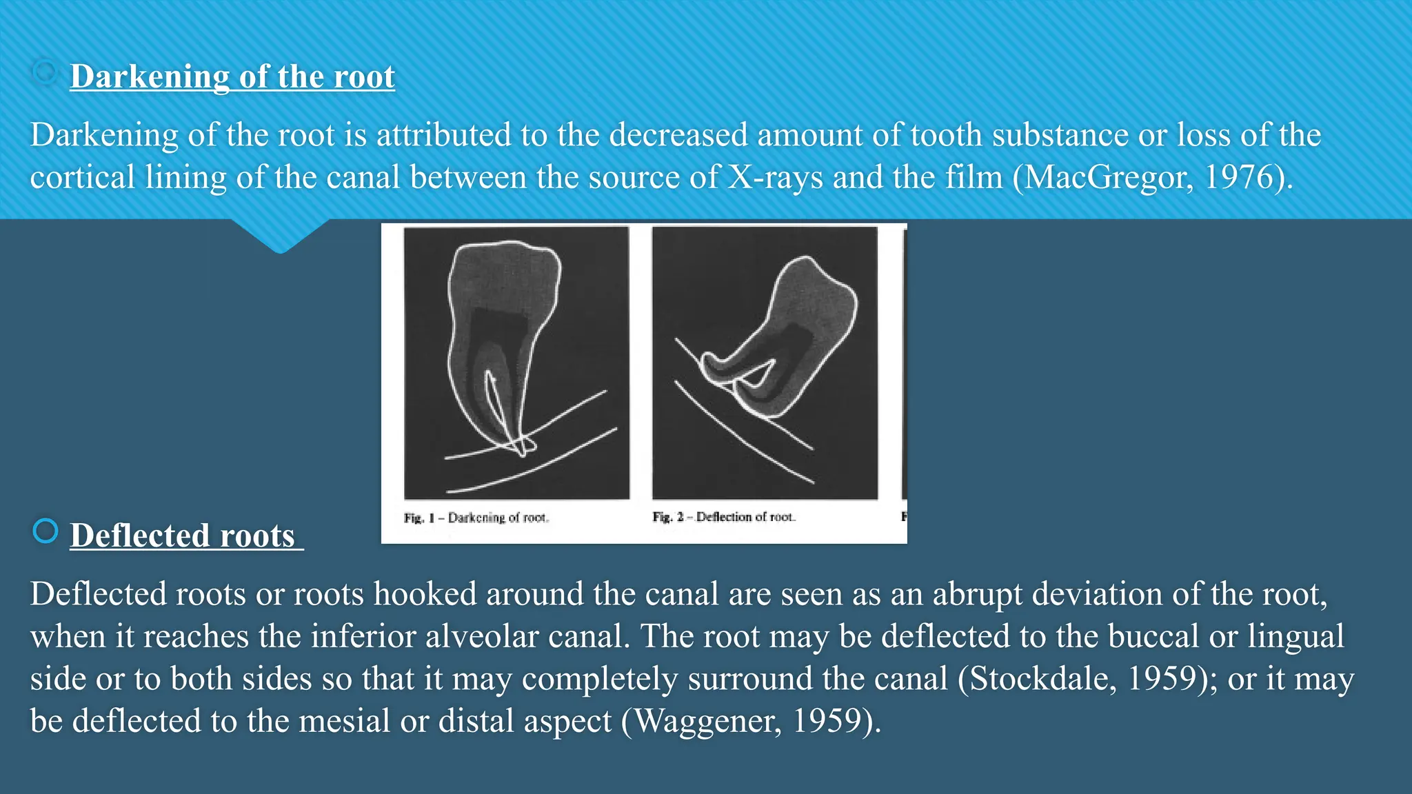  Darkening of the root
Darkening of the root is attributed to the decreased amount of tooth substance or loss of the
cortical lining of the canal between the source of X-rays and the film (MacGregor, 1976).
 Deflected roots
Deflected roots or roots hooked around the canal are seen as an abrupt deviation of the root,
when it reaches the inferior alveolar canal. The root may be deflected to the buccal or lingual
side or to both sides so that it may completely surround the canal (Stockdale, 1959); or it may
be deflected to the mesial or distal aspect (Waggener, 1959).
 