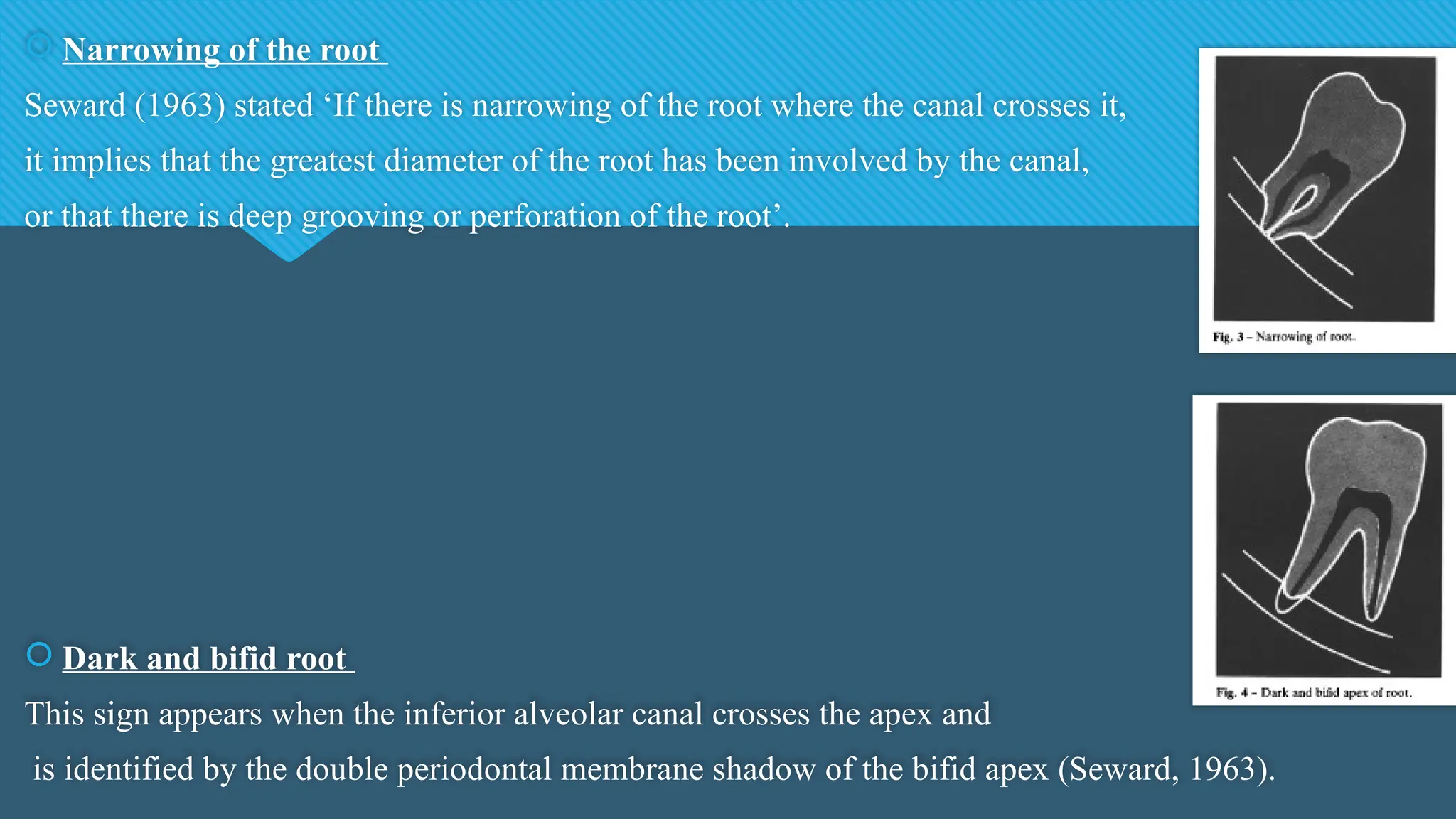  Narrowing of the root
Seward (1963) stated ‘If there is narrowing of the root where the canal crosses it,
it implies that the greatest diameter of the root has been involved by the canal,
or that there is deep grooving or perforation of the root’.
 Dark and bifid root
This sign appears when the inferior alveolar canal crosses the apex and
is identified by the double periodontal membrane shadow of the bifid apex (Seward, 1963).
 