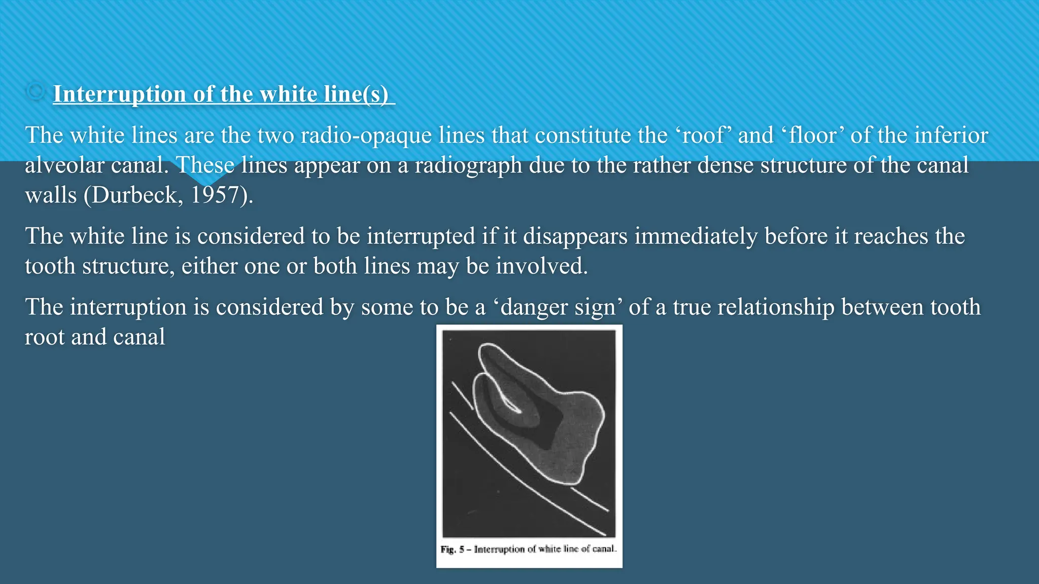  Interruption of the white line(s)
The white lines are the two radio-opaque lines that constitute the ‘roof’ and ‘floor’ of the inferior
alveolar canal. These lines appear on a radiograph due to the rather dense structure of the canal
walls (Durbeck, 1957).
The white line is considered to be interrupted if it disappears immediately before it reaches the
tooth structure, either one or both lines may be involved.
The interruption is considered by some to be a ‘danger sign’ of a true relationship between tooth
root and canal
 