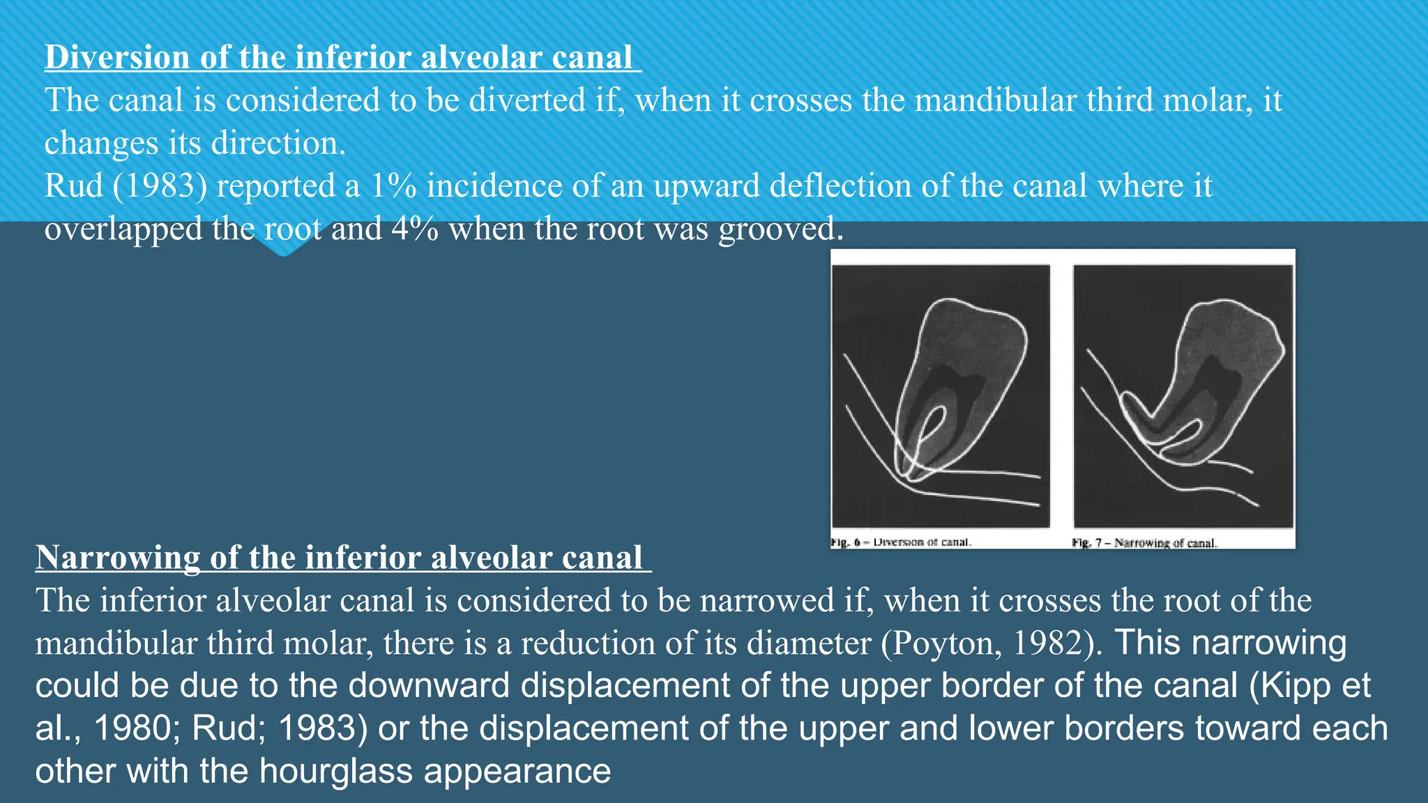 Diversion of the inferior alveolar canal
The canal is considered to be diverted if, when it crosses the mandibular third molar, it
changes its direction.
Rud (1983) reported a 1% incidence of an upward deflection of the canal where it
overlapped the root and 4% when the root was grooved.
Narrowing of the inferior alveolar canal
The inferior alveolar canal is considered to be narrowed if, when it crosses the root of the
mandibular third molar, there is a reduction of its diameter (Poyton, 1982). This narrowing
could be due to the downward displacement of the upper border of the canal (Kipp et
al., 1980; Rud; 1983) or the displacement of the upper and lower borders toward each
other with the hourglass appearance
 