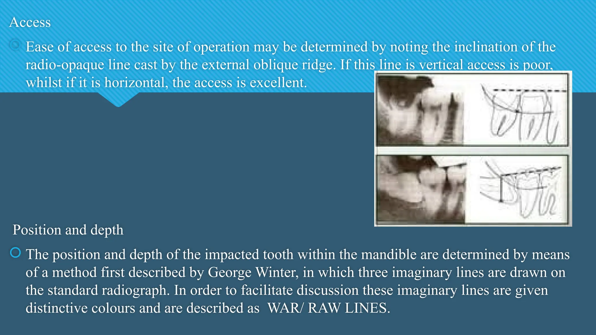 Access
 Ease of access to the site of operation may be determined by noting the inclination of the
radio-opaque line cast by the external oblique ridge. If this line is vertical access is poor,
whilst if it is horizontal, the access is excellent.
Position and depth
 The position and depth of the impacted tooth within the mandible are determined by means
of a method first described by George Winter, in which three imaginary lines are drawn on
the standard radiograph. In order to facilitate discussion these imaginary lines are given
distinctive colours and are described as WAR/ RAW LINES.
 