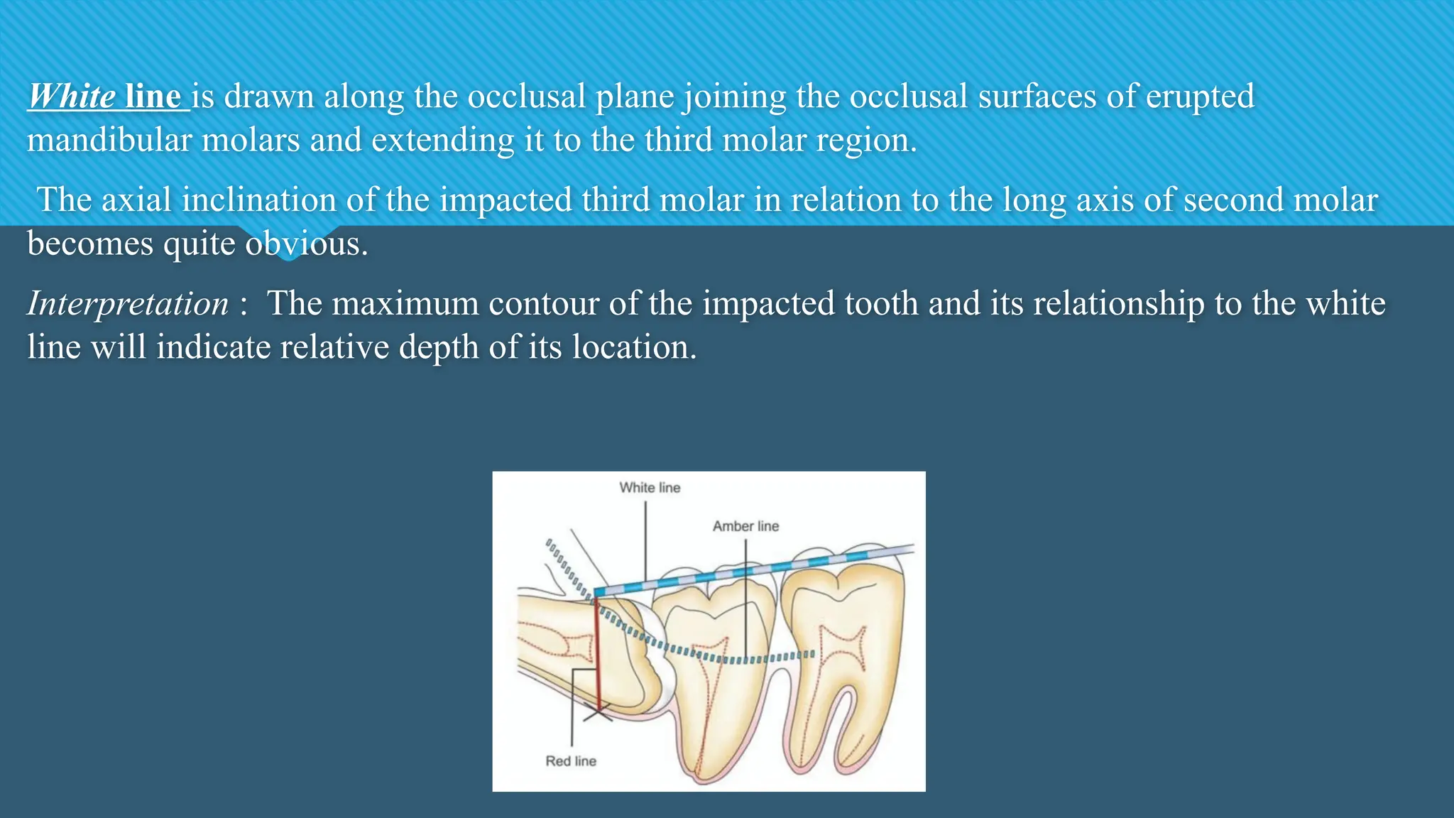 White line is drawn along the occlusal plane joining the occlusal surfaces of erupted
mandibular molars and extending it to the third molar region.
The axial inclination of the impacted third molar in relation to the long axis of second molar
becomes quite obvious.
Interpretation : The maximum contour of the impacted tooth and its relationship to the white
line will indicate relative depth of its location.
 