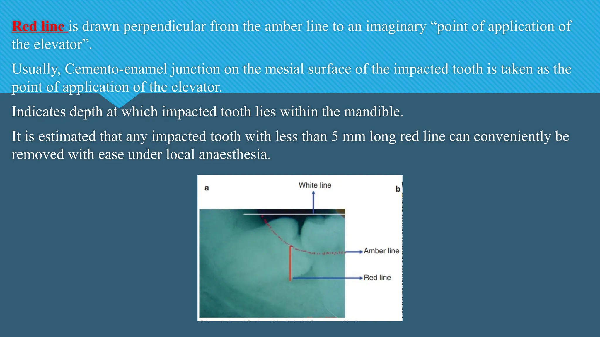 Red line is drawn perpendicular from the amber line to an imaginary “point of application of
the elevator”.
Usually, Cemento-enamel junction on the mesial surface of the impacted tooth is taken as the
point of application of the elevator.
Indicates depth at which impacted tooth lies within the mandible.
It is estimated that any impacted tooth with less than 5 mm long red line can conveniently be
removed with ease under local anaesthesia.
 