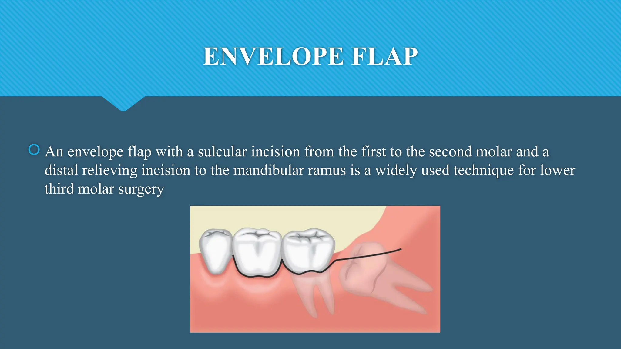 ENVELOPE FLAP
 An envelope flap with a sulcular incision from the first to the second molar and a
distal relieving incision to the mandibular ramus is a widely used technique for lower
third molar surgery
 