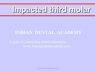 Impacted third molar
INDIAN DENTAL ACADEMY
Leader in continuing dental education
www.indiandentalacademy.com

www.indiandentalacademy.com

 