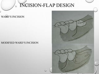INCISION-FLAP DESIGN
WARD’S INCISION
MODIFIED WARD’S INCISION
 