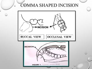 COMMA SHAPED INCISION
 